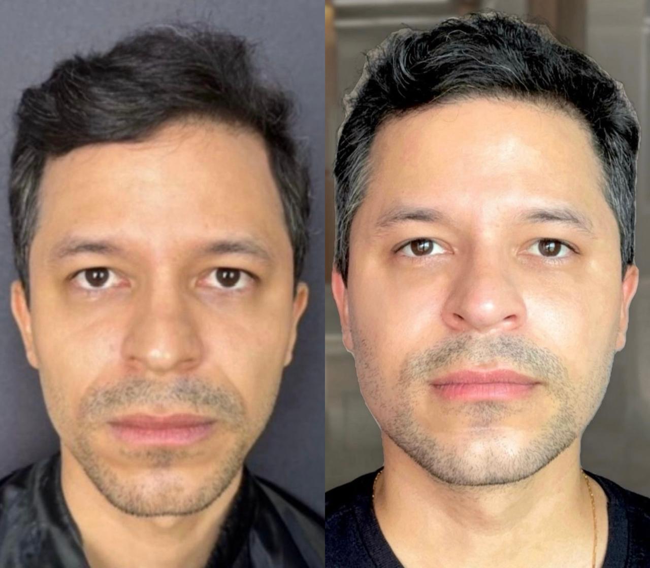 Resultado Harmonização Facial — Antes e Depois